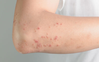 Hives again! What could it be?
